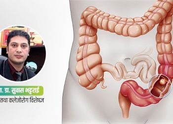 के कारणले हुन्छ ठूलो आन्द्राको क्यान्सर ?